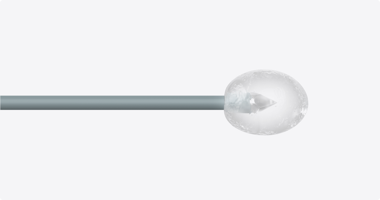 External ice ball- Cryoablation