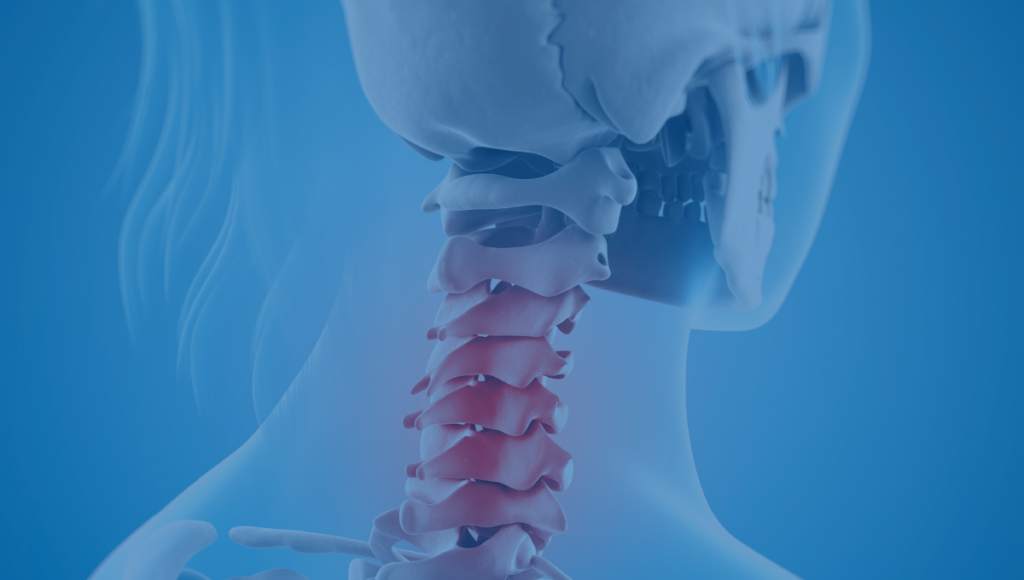 Cryoanalgesia for Occipital Neuralgia