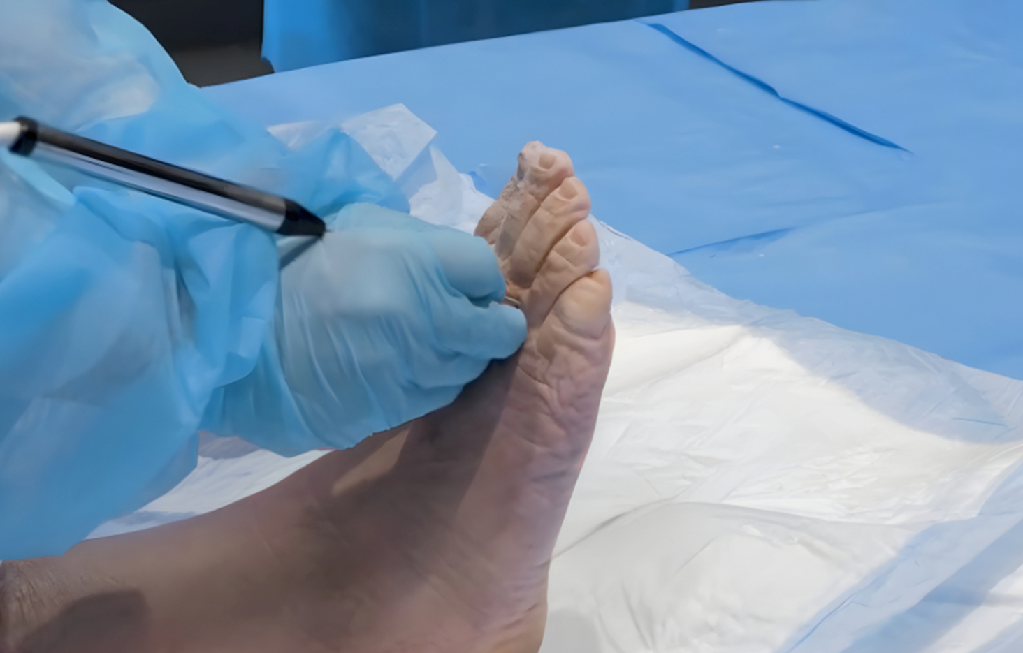 Morton-Neuroma-Cryo-podiatry