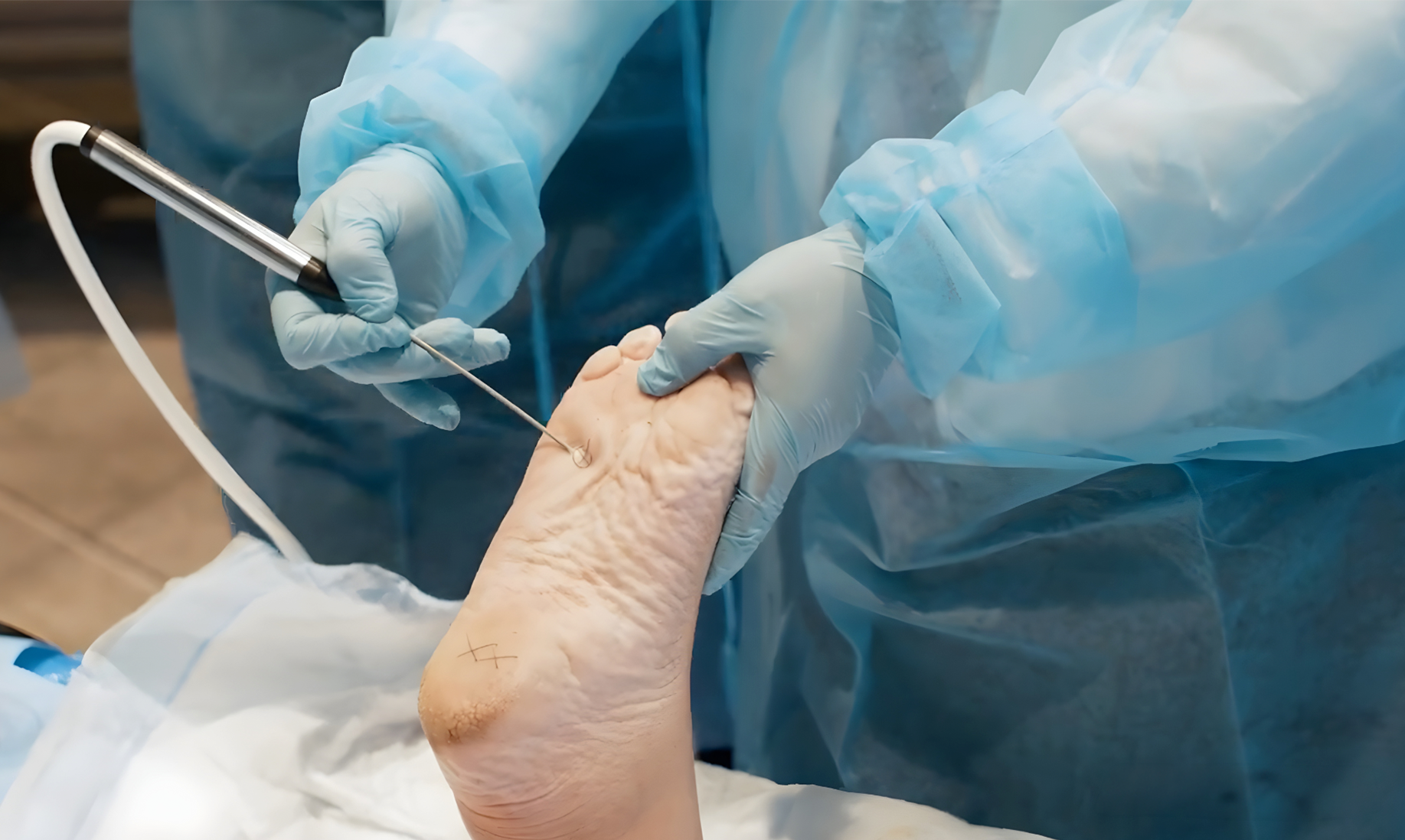 Cryoanalgesia for Verruca