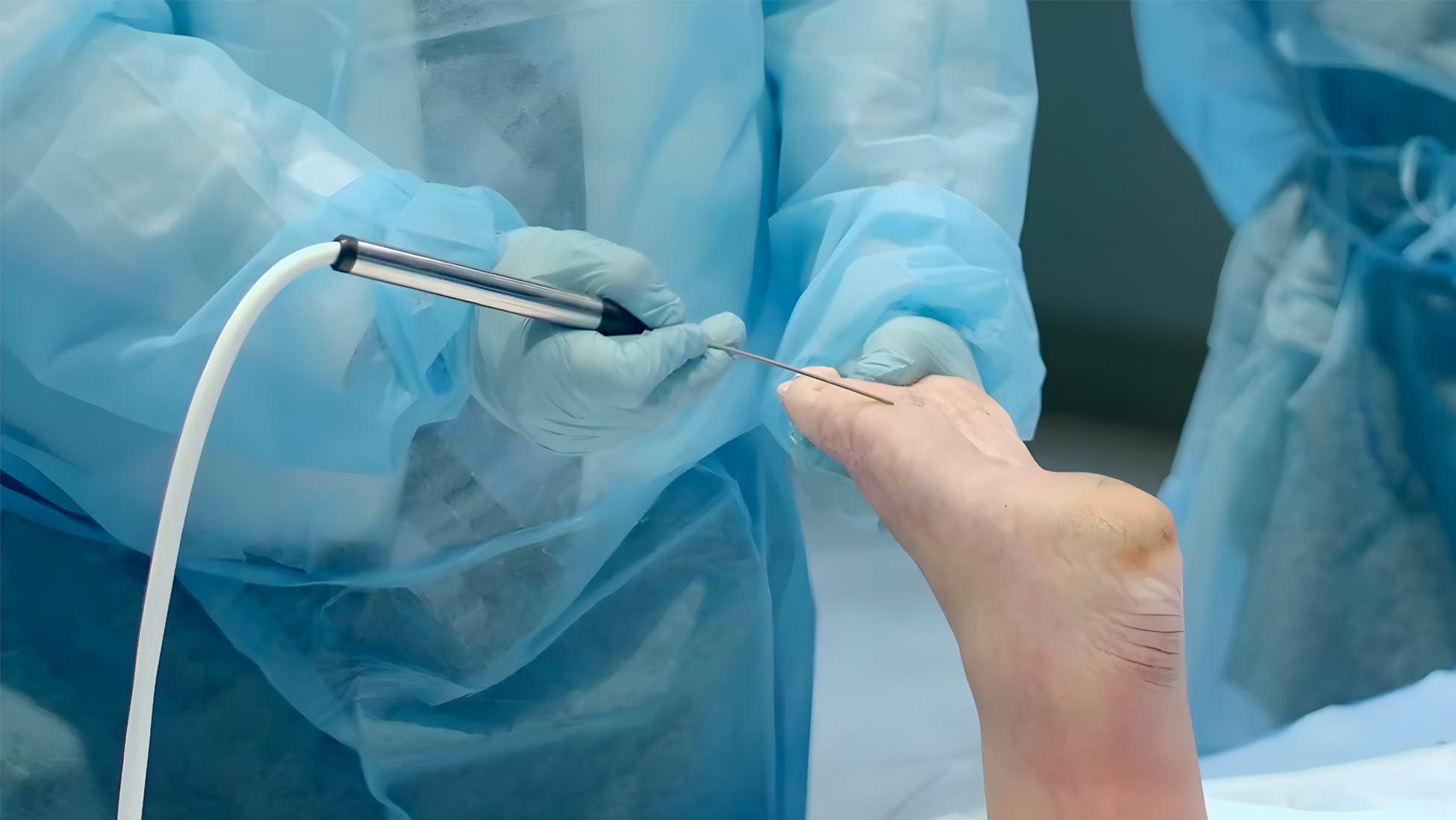 Cryoanalgesia for Bursitis