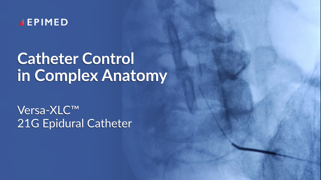 Fluoroscopic image showing epidural catheter navigation in complex spinal anatomy
